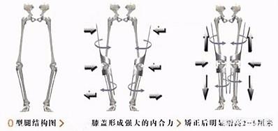 怎么矫正XO型腿，怎么矫正x型腿和罗圈腿（o型腿）