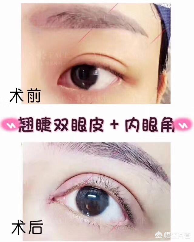 开眼角对比图:割双眼皮不开眼角是一种什么体验？