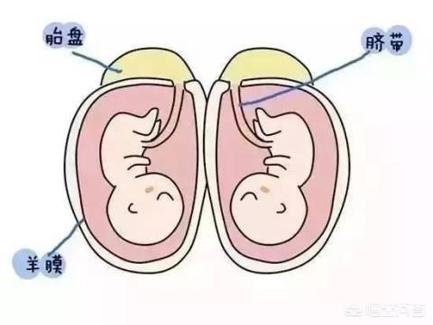 双头女婴:双胞胎是不是都会提前出生是否可以顺产