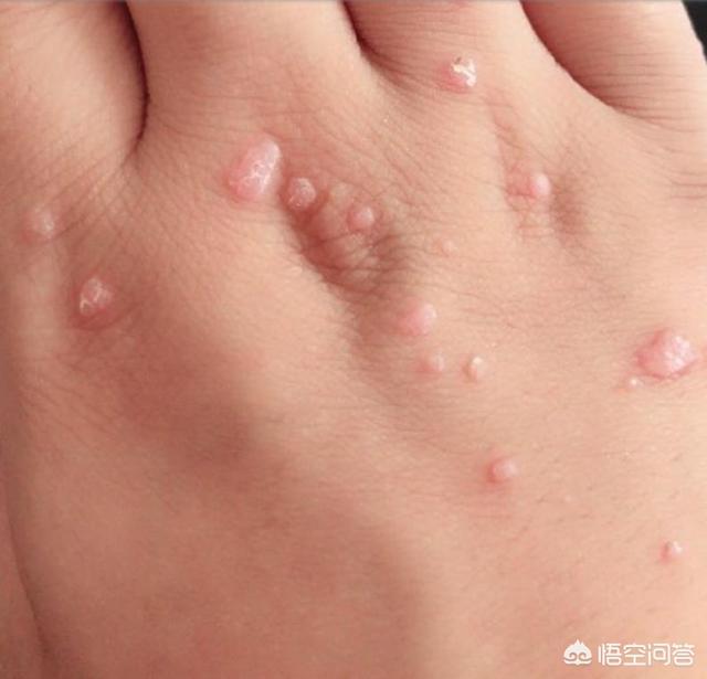70注意新发的扁平疣会以疱疹的形式出现.