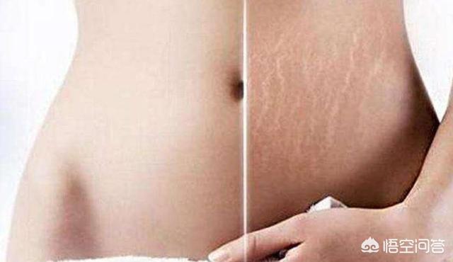 怀孕多久会长妊娠纹？为什么会长妊娠纹？插图41