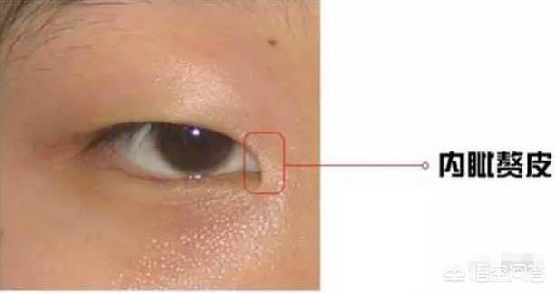 开眼角对比图:割双眼皮不开眼角是一种什么体验？