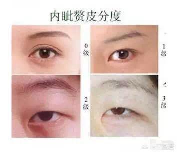 开眼角对比图:割双眼皮不开眼角是一种什么体验？