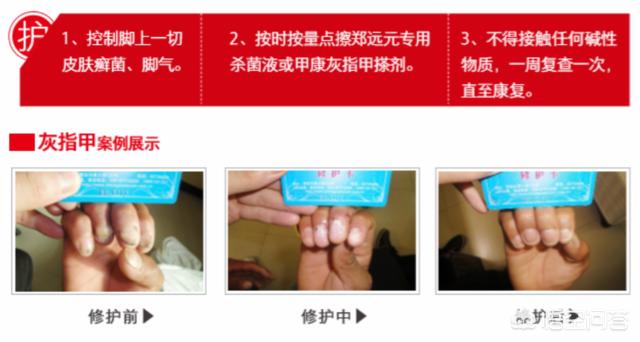抗真菌药物 怎么吃:抗真菌药物怎么吃 灰指甲是吃药好还是擦药好啊？