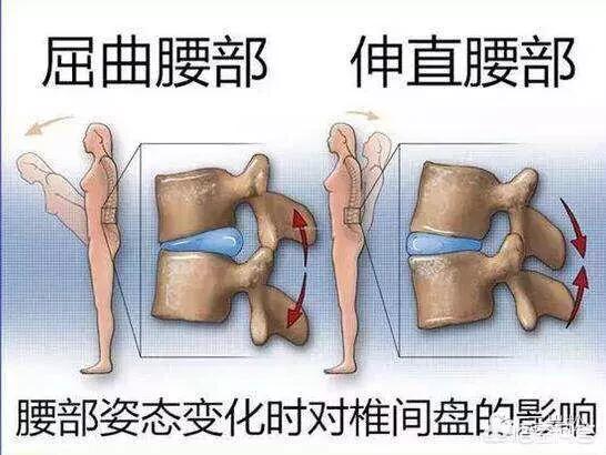 腰沐刻机椎间盘突出怎么治疗:腰椎舒缓器可以治疗椎间盘膨出吗 目前腰间盘突出手术成功率有多少？小手术效果如何？