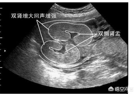 四维b超单，可以看出宝宝是男是女吗