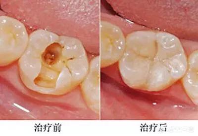 轻度四环素牙是什么颜色:牙齿发黑是什么原因？是蛀牙吗？