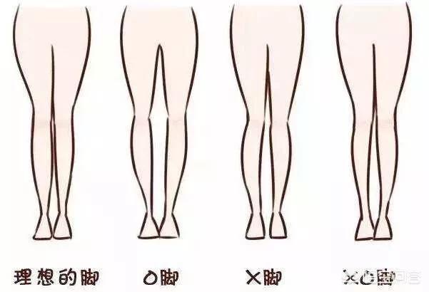 怎么矫正XO型腿，xo型腿应该如何做深蹲和跑步呢？
