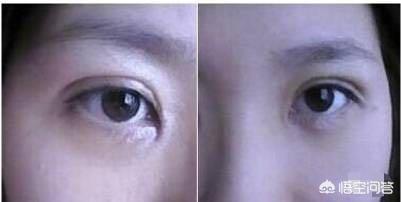 开眼角对比图:割双眼皮不开眼角是一种什么体验？