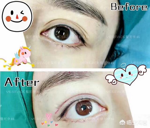 开眼角对比图:割双眼皮不开眼角是一种什么体验？