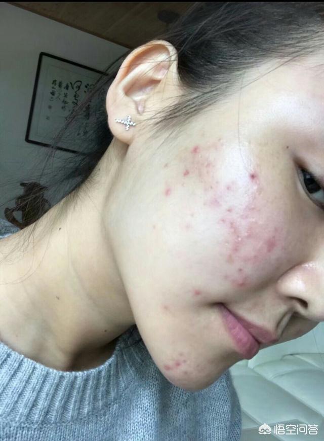 祛痘秘方(祛痘配方)