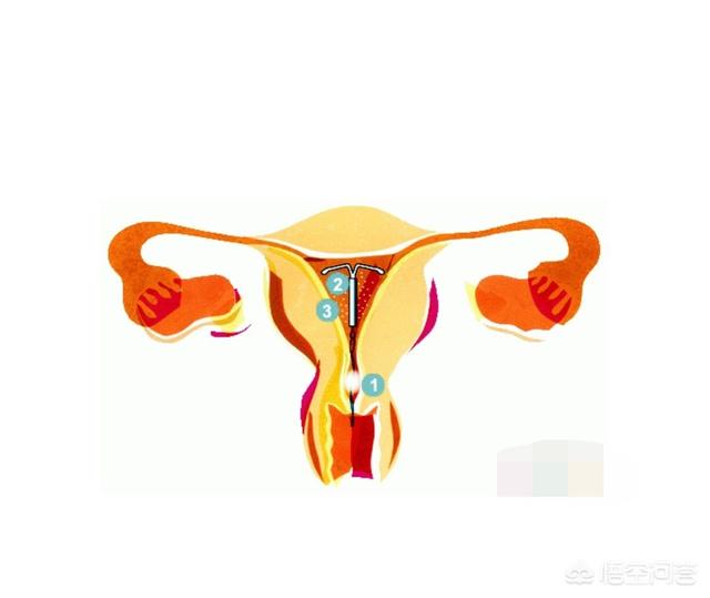 为啥带环后易发生宫外孕，女人上环时间久了，对身体有影响吗