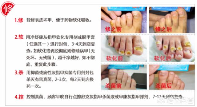 抗真菌药物 怎么吃:抗真菌药物怎么吃 灰指甲是吃药好还是擦药好啊？