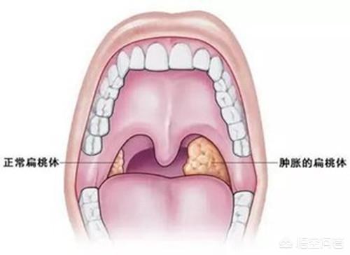 一岁十个月的宝宝化脓性扁桃体炎反复高烧应该怎么办