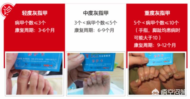 抗真菌药物 怎么吃:抗真菌药物怎么吃 灰指甲是吃药好还是擦药好啊？