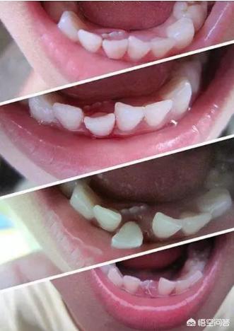 头条问答 - 为防止暴牙,一颗乳牙松动多久必须拔掉?(3个回答)