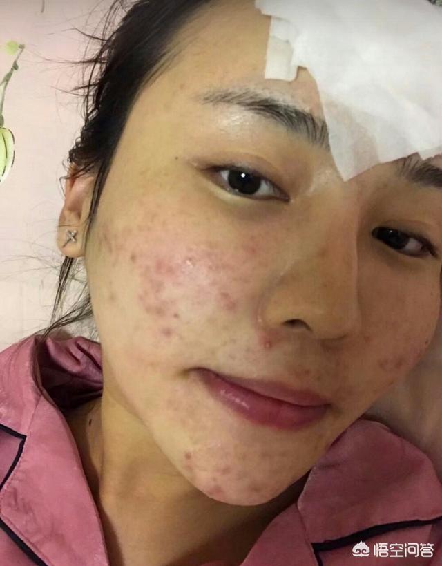 祛痘秘方(祛痘配方)