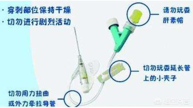 静脉留置针:静脉留置针可以留几天 医院要求患者用静脉留置针吗？