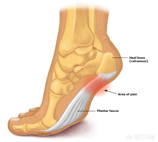 足底筋膜炎有什么征兆，脚底筋膜炎的症状及治疗是什么