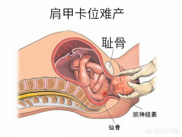 什么是难产:难产体质的孕妇有什么特征？该如何改善？