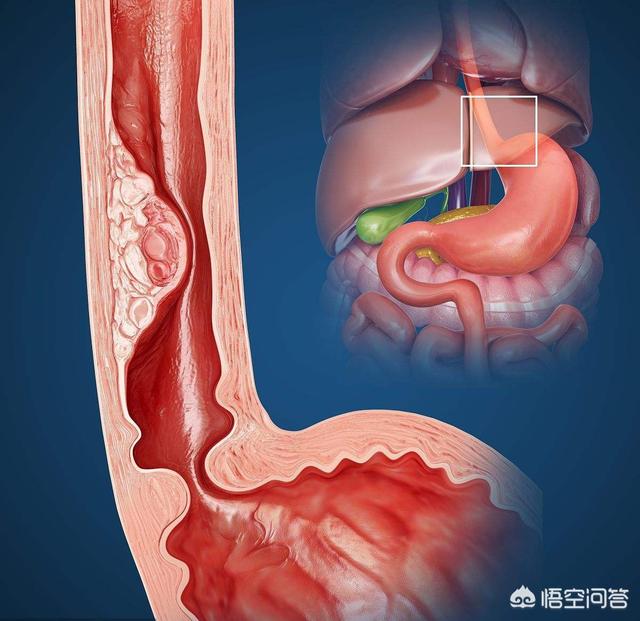 不影响寿命的十大癌症:哪种癌症最可怕？癌症早期能治好吗？