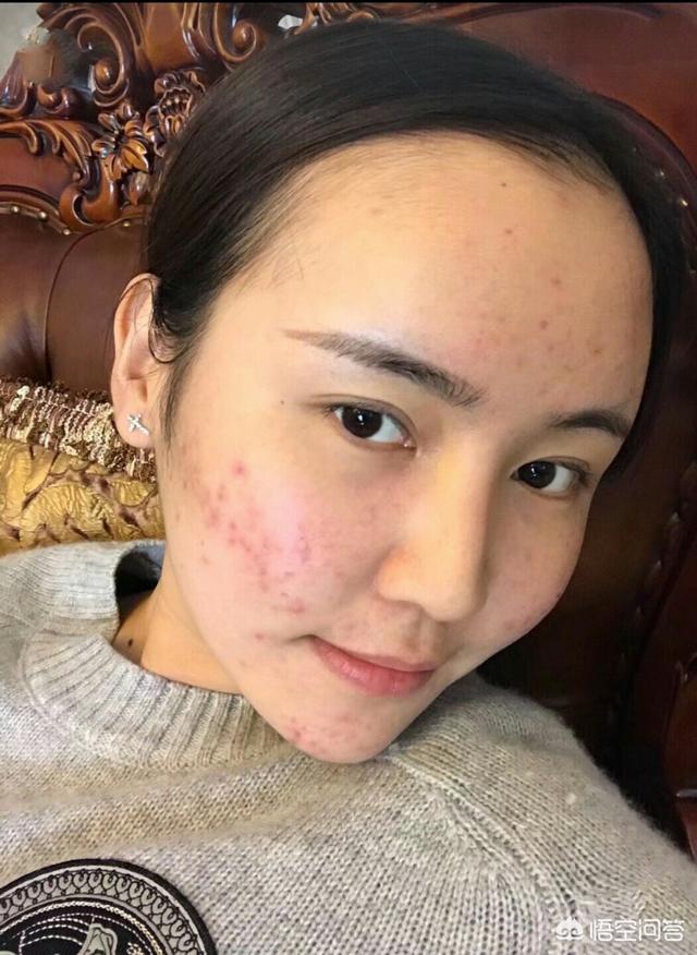 祛痘秘方(祛痘配方)