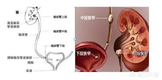 泌尿系统结石:尿路结石应该做哪些检查？