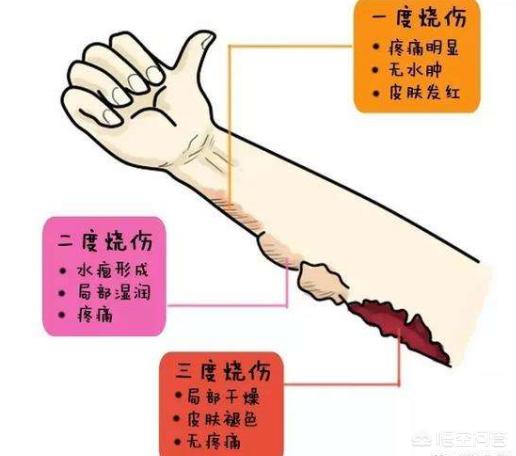 头条问答 被100 开水烫伤属于什么级别的烫伤 会留疤吗 烫伤后该如何处理 9个回答