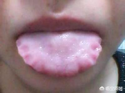 舌头胖大有齿痕，需要怎么调理？插图33