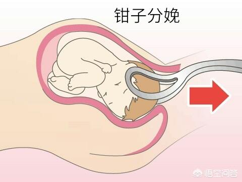 什么是难产:难产体质的孕妇有什么特征？该如何改善？