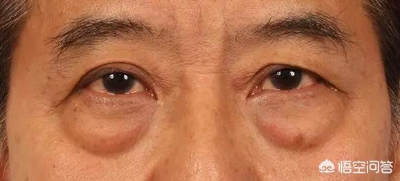 如何区分眼袋和泪沟？