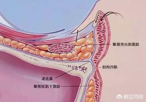 如何区分眼袋和泪沟？