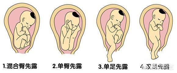 臀位生孩子前的征兆:臀位快生了的征兆感觉 孕妇臀位，宝宝是怎么生出来的？