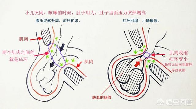 头条问答 - 小儿疝气发生嵌顿的原因是什么?(2个回答)