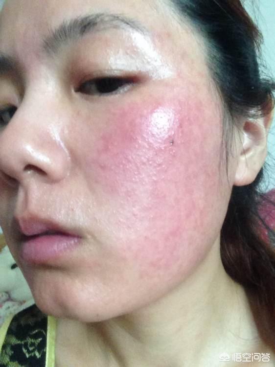 头条问答 - 有激素纹怎么办?(7个回答)