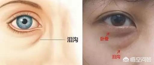 如何区分眼袋和泪沟？
