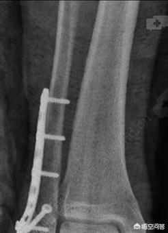 头条问答 腓骨骨折用不用动手术 4个回答