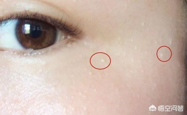 长了脂肪粒怎么办？