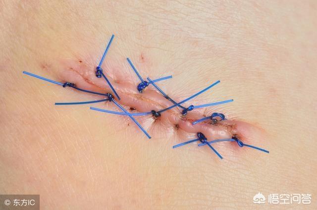 很多患者说伤口处的皮肤已经愈合了,但是过了一段时间肛瘘手术后吃