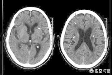 左侧小脑室旁脑梗塞严重吗，左侧侧脑室旁脑梗塞严重吗