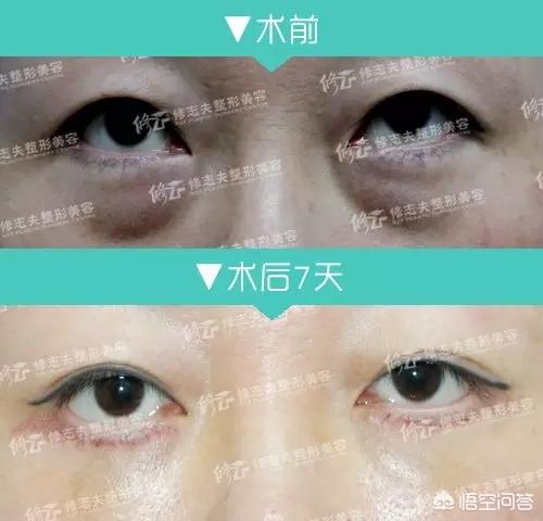如何区分眼袋和泪沟？