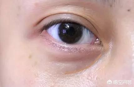 如何区分眼袋和泪沟？
