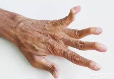 搜索风湿性关节炎的症状手:手指关节痛是类风湿吗？手指关节类风湿会有哪些症状？