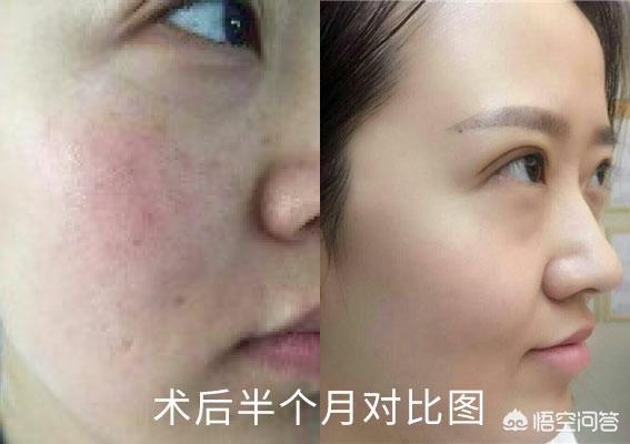作激光能净化血液吗:脸上的红血丝可以去掉吗？