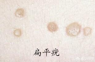 蜘蛛痣图片:身上长红色的瘊子是怎么回事？应该怎么办？