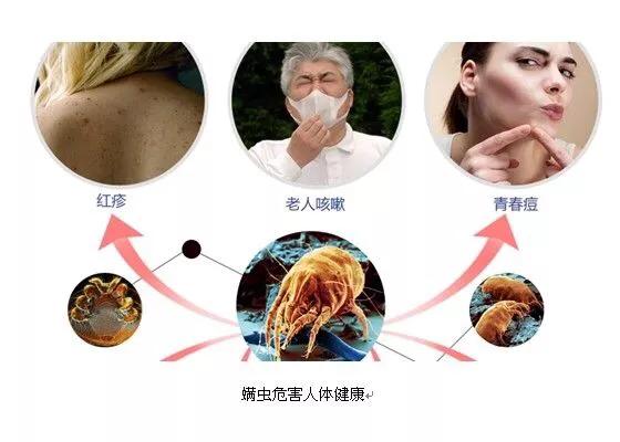 床上生螨虫怎么处理:怎么去除床上、沙发上、衣服里的螨虫？