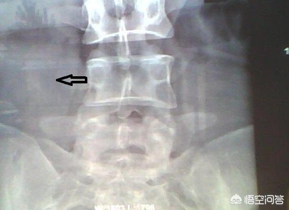 头条问答 腰椎横突骨折愈合后该怎样恢复 需要注意什么 4个回答
