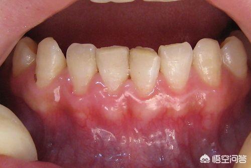 头条问答 - 上牙内侧牙龈肿,该怎么缓解?(大脸猫体育快讯的回答,0赞)