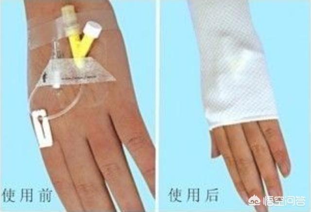 静脉留置针:静脉留置针可以留几天 医院要求患者用静脉留置针吗？