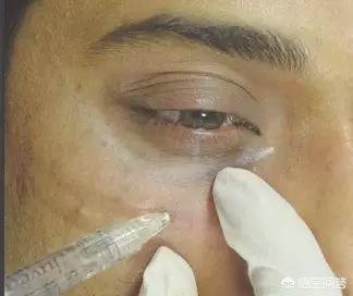 如何区分眼袋和泪沟？